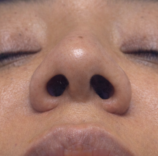 Before/After Image